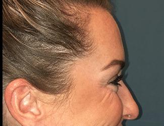Botox Before & After Patient #8821