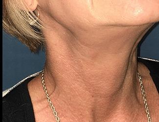 Botox Before & After Patient #8820