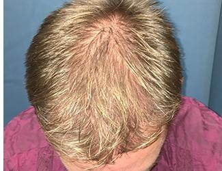 NeoGraft Before & After Patient #8827