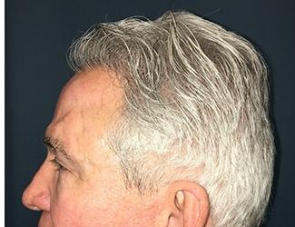 NeoGraft Before & After Patient #8826