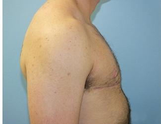 Female to Male Before & After Patient #8440