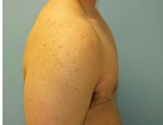 Female to Male Before & After Patient #8444