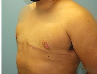 Female to Male Before & After Patient #8438