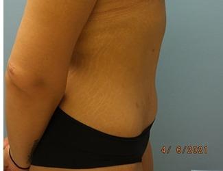 Tummy Tuck Before & After Patient #8197