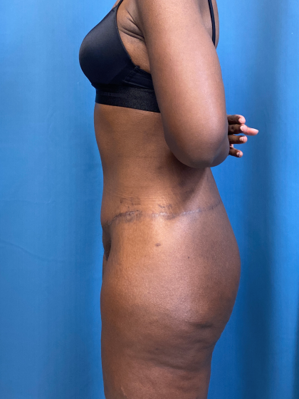 Lower Body Lift Before & After Patient #8029