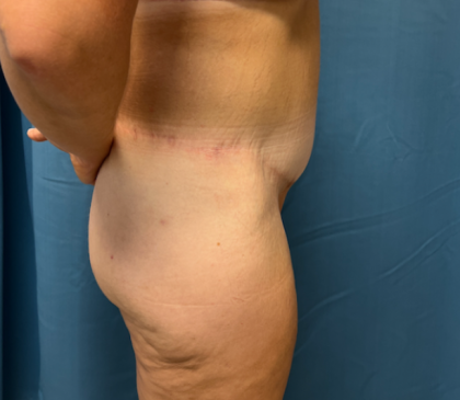 Lower Body Lift Before & After Patient #8028