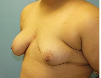 Female to Male Before & After Patient #8437