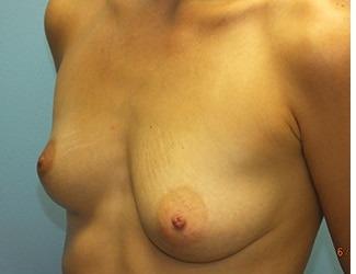Breast Augmentation Before & After Patient #8246