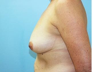 Breast Augmentation Before & After Patient #8244