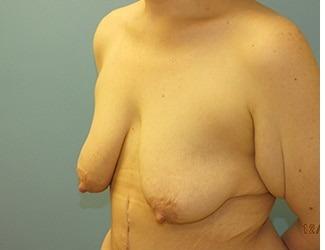 Breast Lift/Mastopexy Before & After Patient #8370