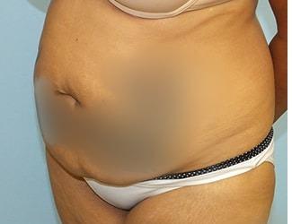 Tummy Tuck Before & After Patient #8199