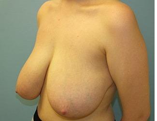 Breast Reduction Before & After Patient #8417