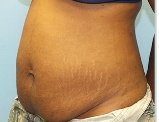 Tummy Tuck Before & After Patient #8195