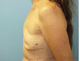 Breast Revision Before & After Patient #8240
