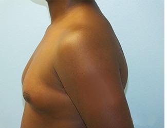 Gynecomastia Before & After Patient #8443