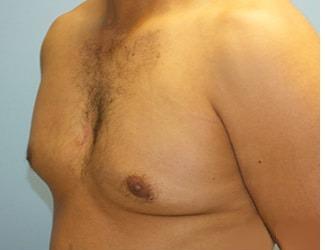 Gynecomastia Before & After Patient #8441