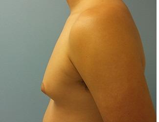 Gynecomastia Before & After Patient #8439