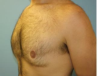 Gynecomastia Before & After Patient #8435