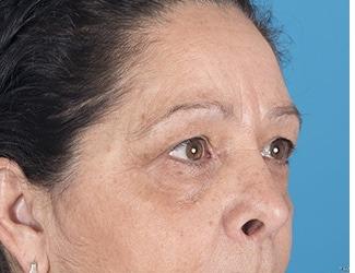 Browlift Before & After Patient #8461