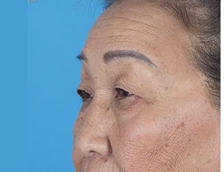 Browlift Before & After Patient #8457
