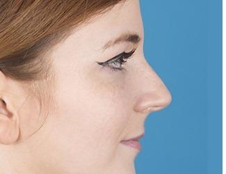 Rhinoplasty Before & After Patient #8809