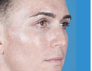 Rhinoplasty Before & After Patient #8808