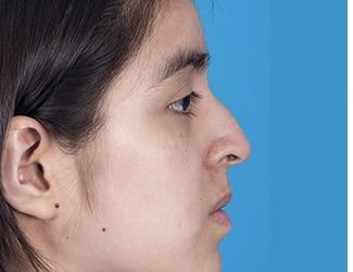 Rhinoplasty Before & After Patient #8807