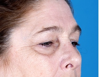 Blepharoplasty Before & After Patient #8533