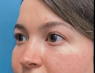 Blepharoplasty Before & After Patient #8485
