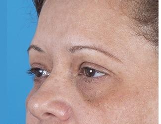 Blepharoplasty Before & After Patient #8481