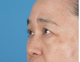 Blepharoplasty Before & After Patient #8483