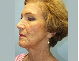 Facial Fat Grafting Before & After Patient #8745