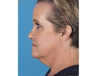 Facial Fat Grafting Before & After Patient #8741