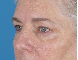Facial Fat Grafting Before & After Patient #8744