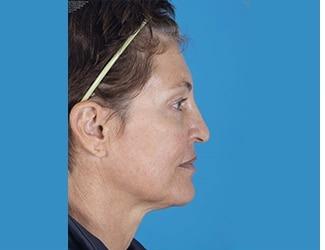 Facial Fat Grafting Before & After Patient #8742