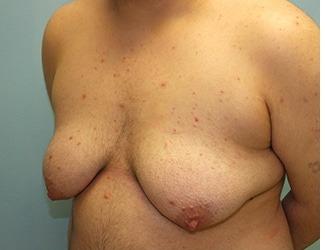 Female to Male Before & After Patient #8442