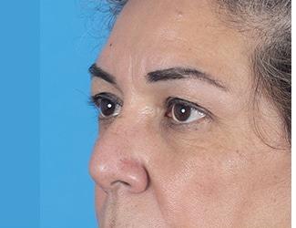 Facial Fat Grafting Before & After Patient #8743