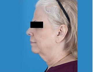 Facial Fat Grafting Before & After Patient #8740