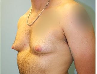 Female to Male Before & After Patient #8440