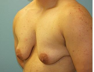 Female to Male Before & After Patient #8444