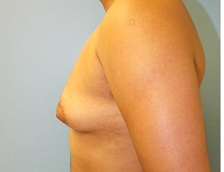Female to Male Before & After Patient #8438