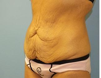 Tummy Tuck Before & After Patient #8197