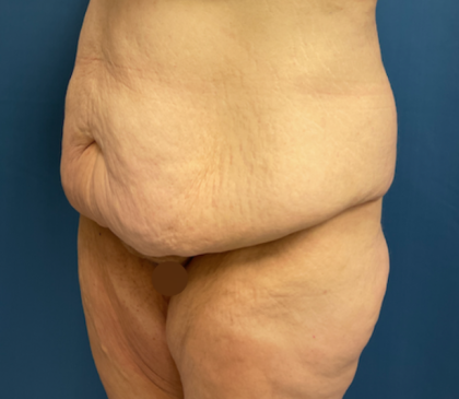 Lower Body Lift Before & After Patient #8028