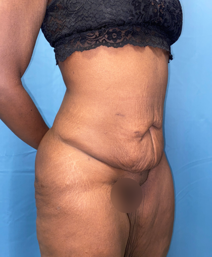 Tummy Tuck Before & After Patient #8204