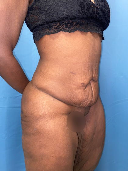 Lower Body Lift Before & After Patient #8029