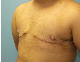 Female to Male Before & After Patient #8437