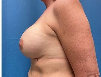 Breast Augmentation Before & After Patient #8244