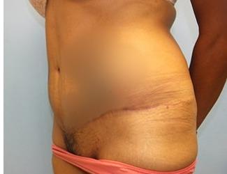 Tummy Tuck Before & After Patient #8199