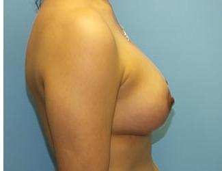Breast Lift/Mastopexy Before & After Patient #8371