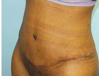 Tummy Tuck Before & After Patient #8195